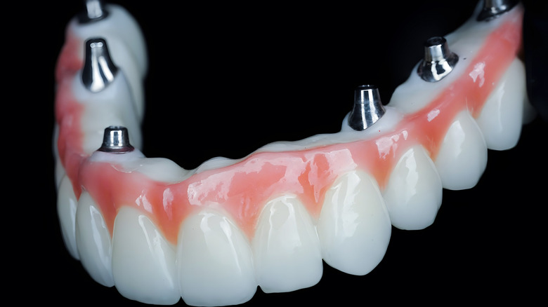 full upper arch of dental implants