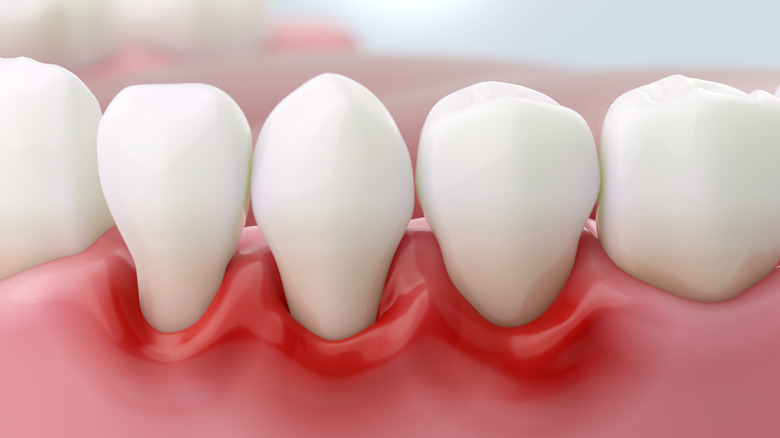 bottom row of teeth show gum inflammation surrounding three teeth