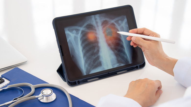 Someone looking at a lung cancer test on a tablet.